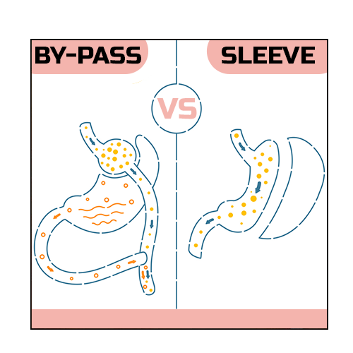 différence entre sleeve et by pass