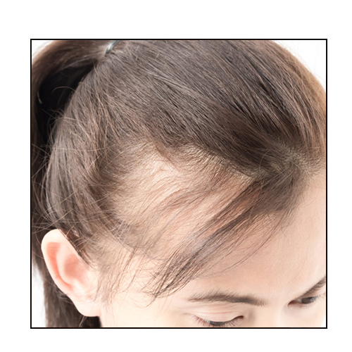 greffe de cheveux femme