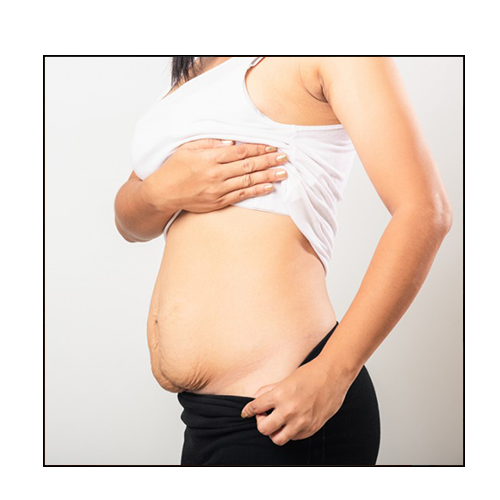 VENTRE APRÈS ACCOUCHEMENT