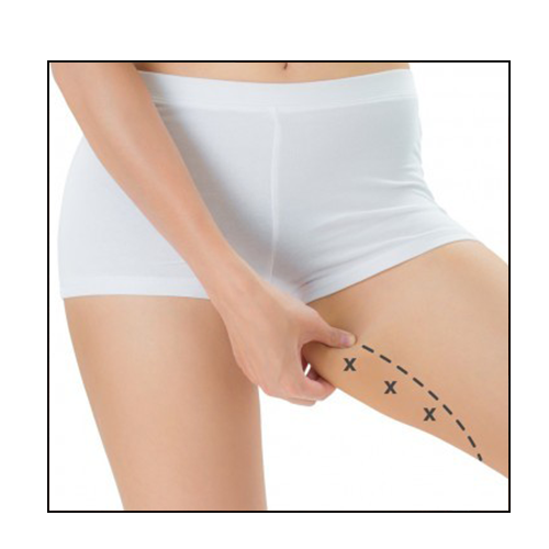 liposuccion intérieur cuisses