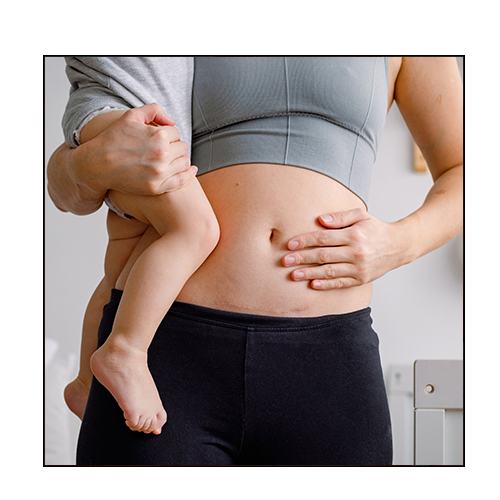 Ventre abimé apres grossesse