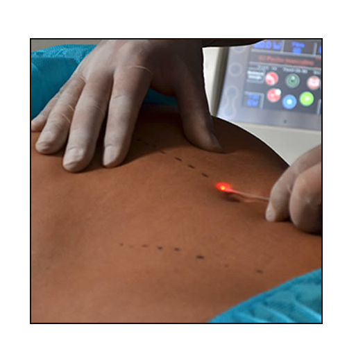 Liposuccion laser en Tunisie