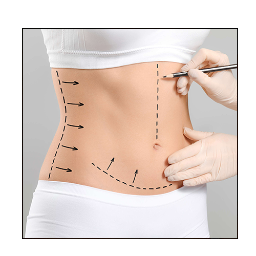 abdominoplastie ou liposuccion